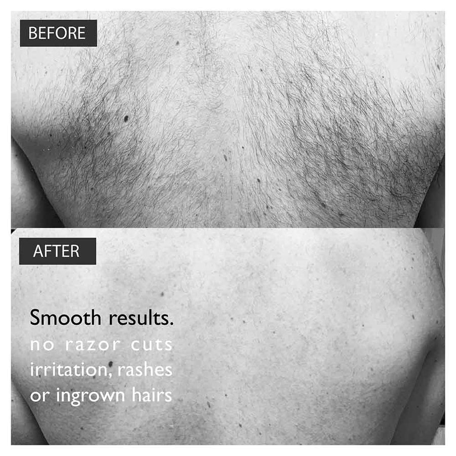Baldape Silverback Back & Body Hair Removal Kit