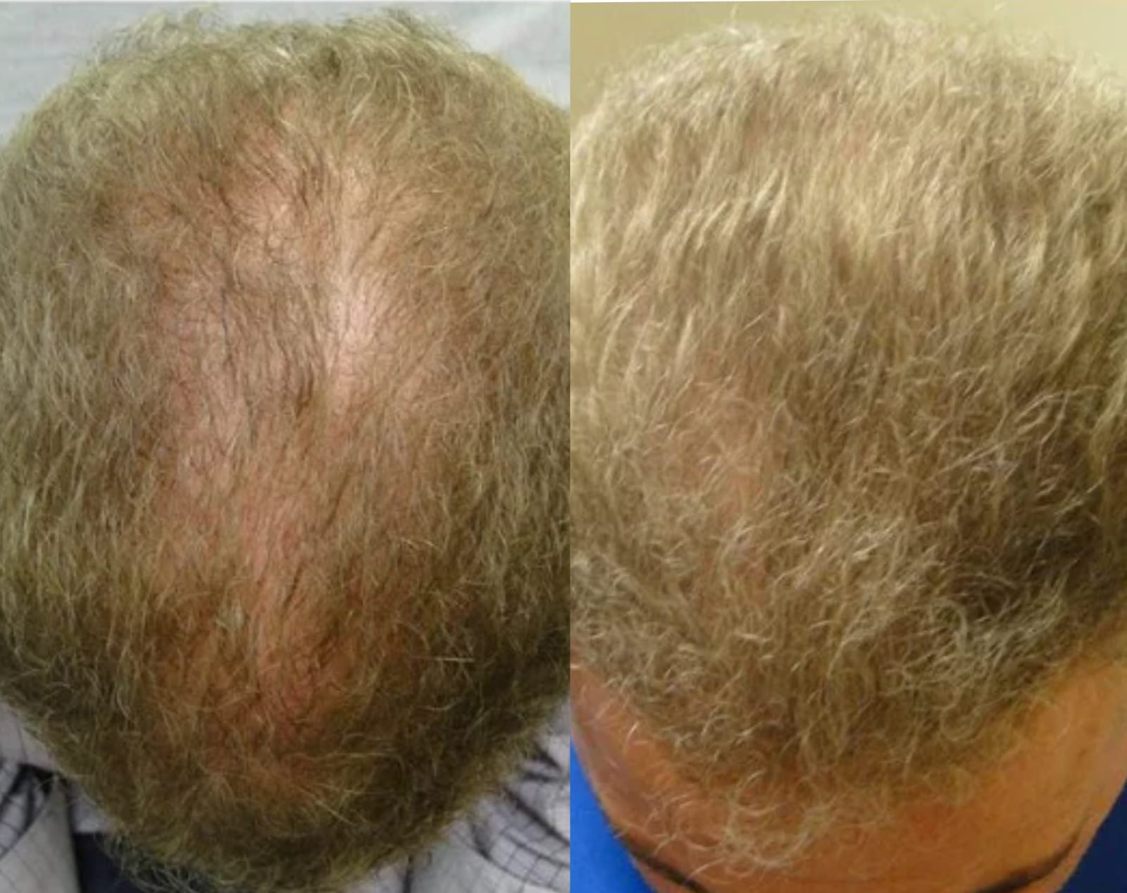 Lustrao Hair Regrowth Oil – Follicle Revival