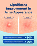 POINTMASS Pimple Patches – Invisible 0.1mm Hydrocolloid with Tea Tree Oil | 132 Dots, 2 Sizes